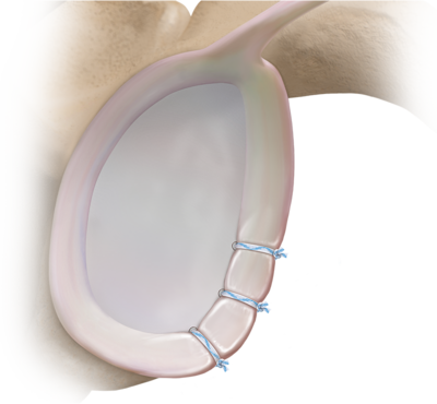 Labrum Schulter